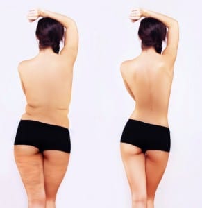 fat freezing