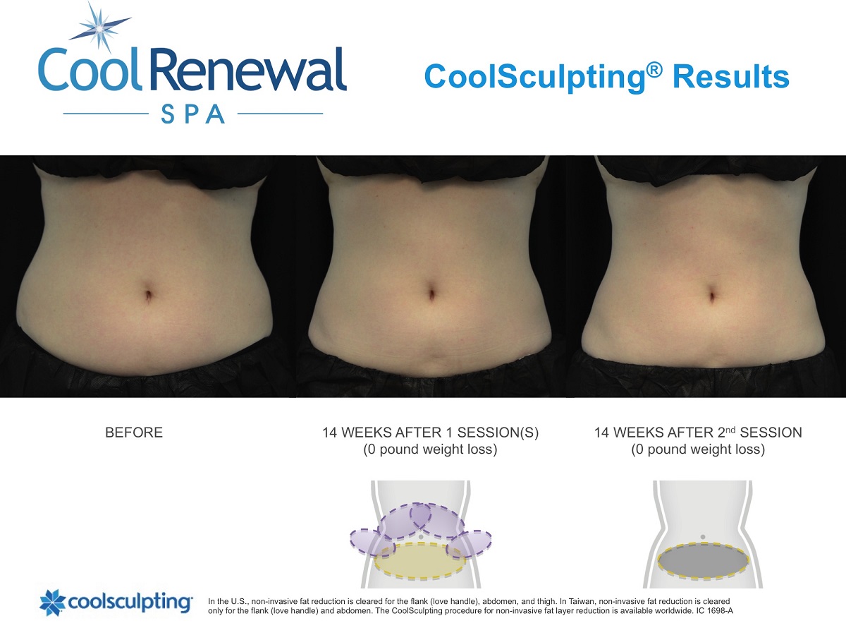 Before & After  Cool Renewal Spa