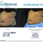 Liposuction Alternative in Rock Hill, South Carolina