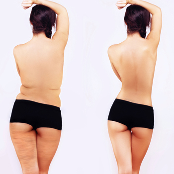 Keep The Love, Lose The Love Handles With CoolSculpting