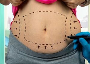 How Fat Freezing Works