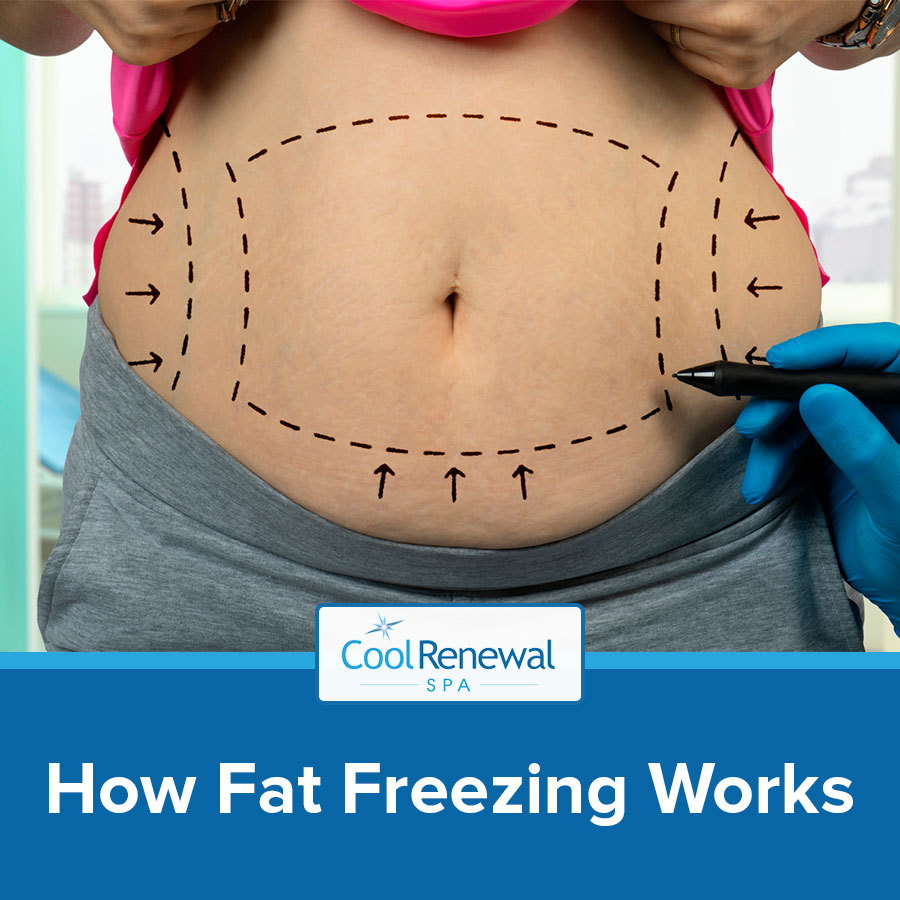 How Fat Freezing Works