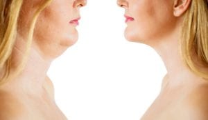 Fat Removal Options: Which is Right For You?