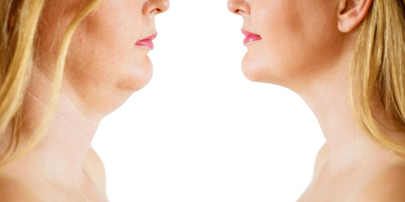 Fat Removal Options: Which is Right For You?
