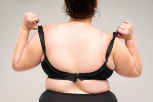 Are Fat Removal Treatments Right for You?