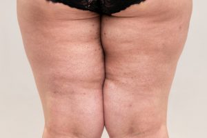 Should You Consider Body Sculpting Treatments?