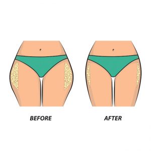 DualSculpting: What You Need to Know