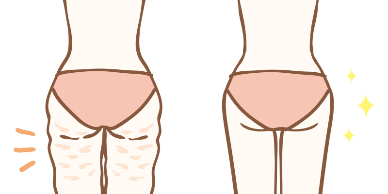 The Amazing Benefits of CoolSculpting