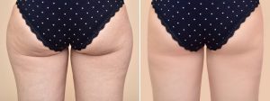 The Phenomenal Benefits of Body Sculpting