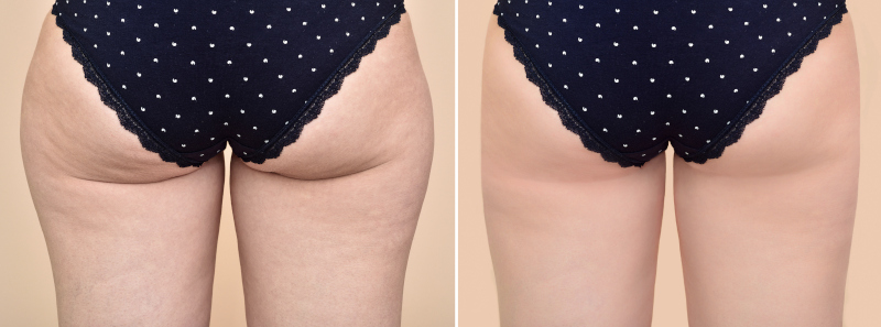 The Phenomenal Benefits of Body Sculpting